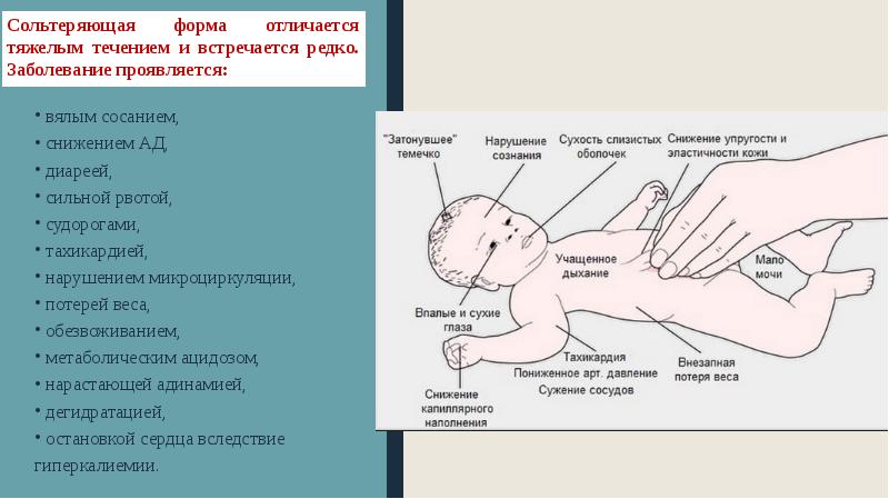 Дисфункция надпочечников у ребенка врожденная. Адреногенитальный синдром. Адреногенитальный синдром сольтеряющая. Адреногенитальным синдромом сольтеряющей формы. Гипертоническая форма адреногенитального синдрома.