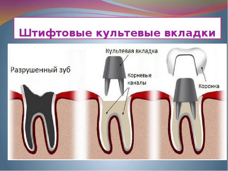 Культевая вкладка схема