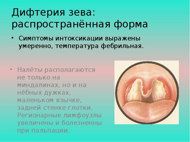 Передача возбудителя дифтерии возможна ответ. Локализованная дифтерия зева. Дифтерия зева профилактика.