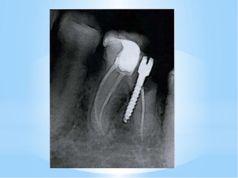 Повторное эндодонтическое лечение презентация