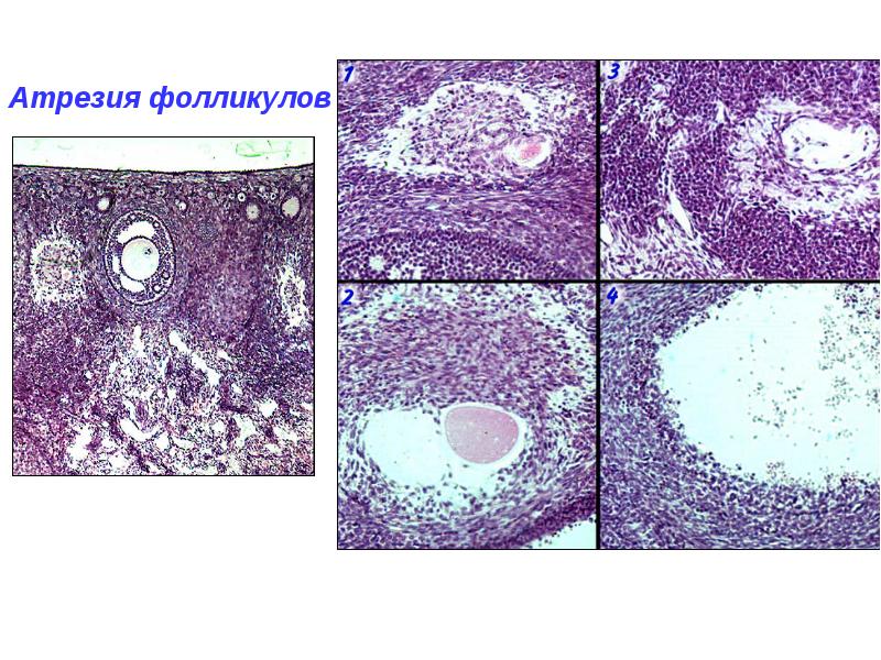 Первичный полом. Атрезия фолликула. Механизм атрезии фолликулов. Атрезия фолликула клиника. Атрезия фолликулов преобладают крупные.