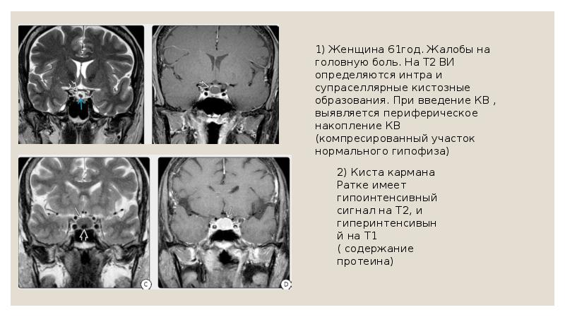 Мр картина микроаденома гипофиза