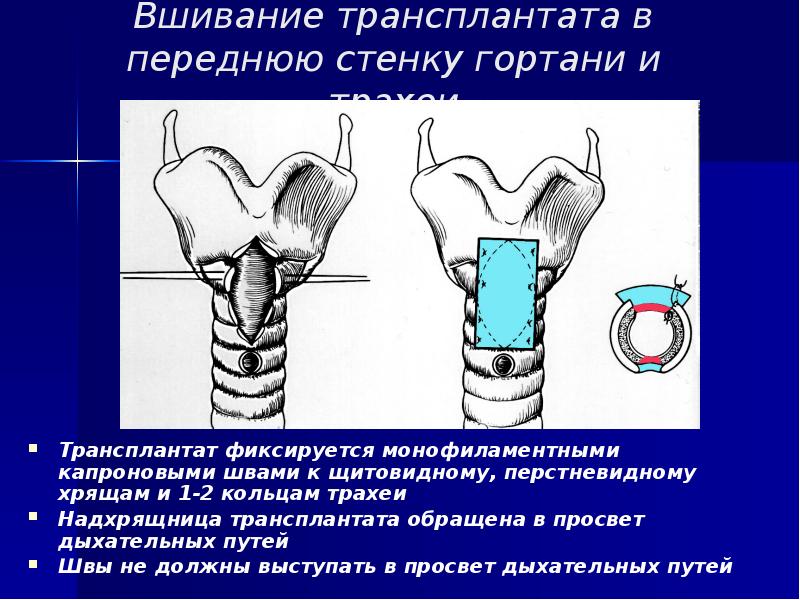 Передняя стенка трахеи