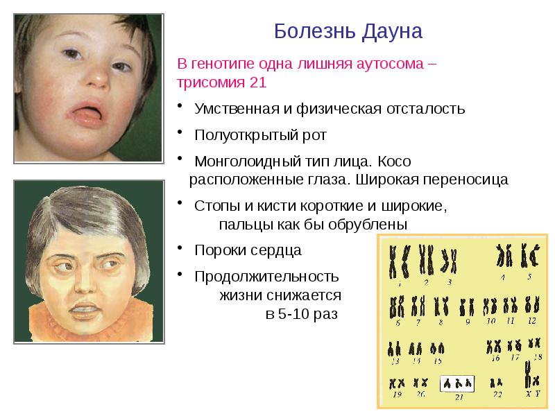 Хромосомные заболевания дауна. Болезнь Дауна трисомия 21. Синдром Дауна (трисомия по 21 паре хромосом). Болезнь Дауна трисомия. Синдром Дауна трисомия по.