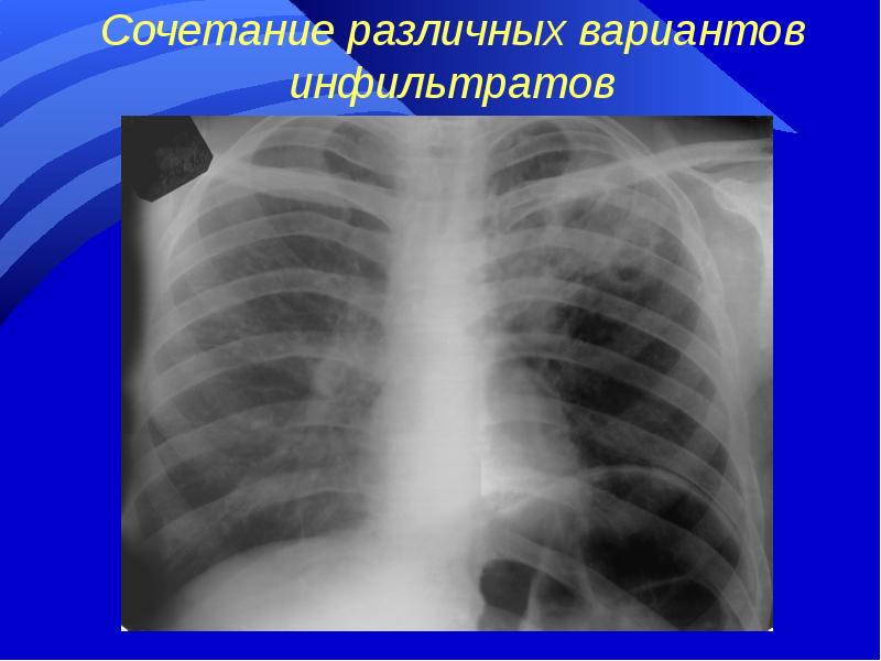 Инфильтрат молочной. Бронхолобулярный инфильтрат рентген. Муфтообразный инфильтрат. Поверхностные инфильтраты.