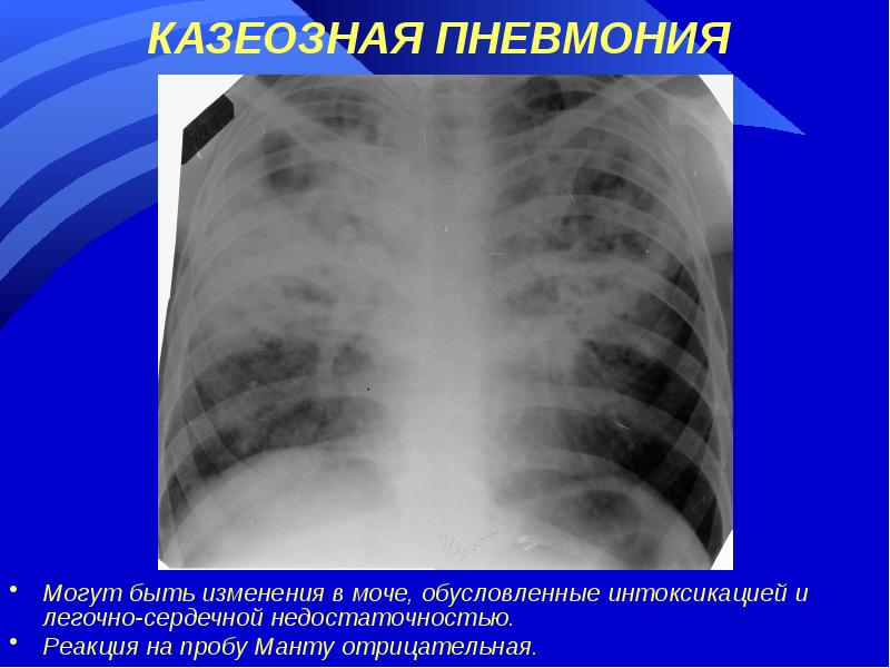 Клиническая картина казеозной пневмонии обычно характеризуется