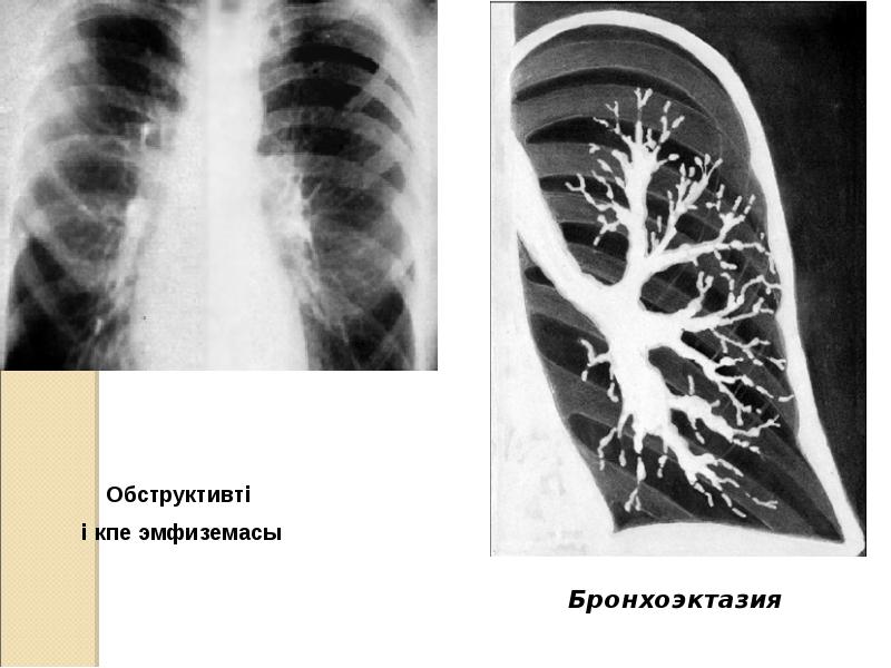 Жедел бронхит презентация