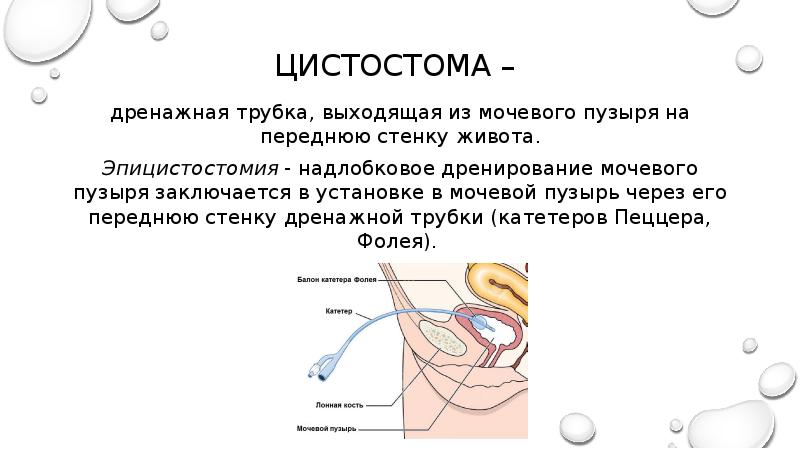 Уход за цистостомой презентация