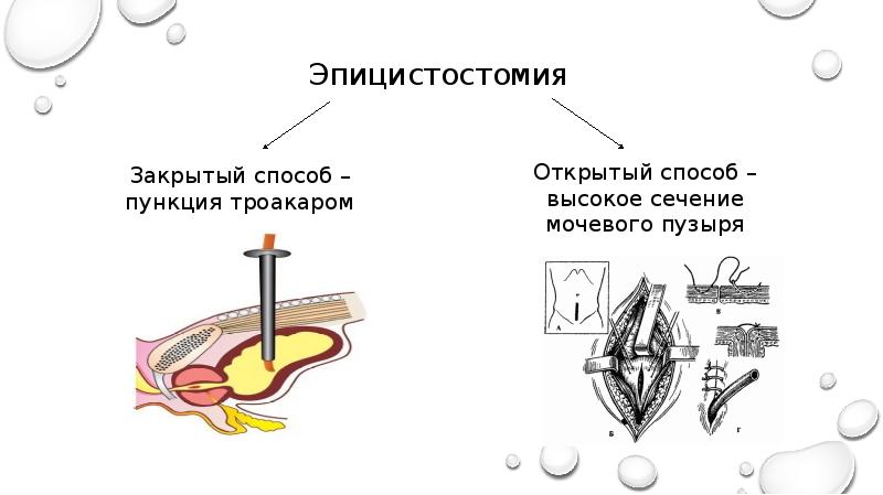 Пункция мочевого пузыря презентация