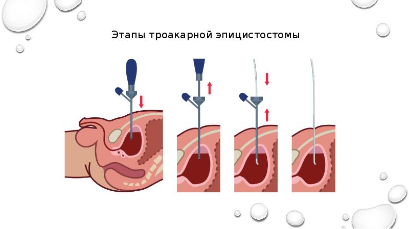 Пункция мочевого пузыря презентация