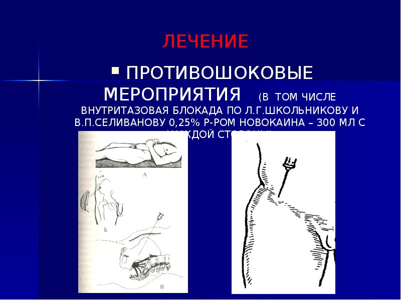 Блокада по лорин эпштейну. Тазовые новокаиновые блокады. Внутритазовая блокада по Школьникову-Селиванову. Тазовая блокада по Школьникову. Методика проведения блокады по Школьникову.