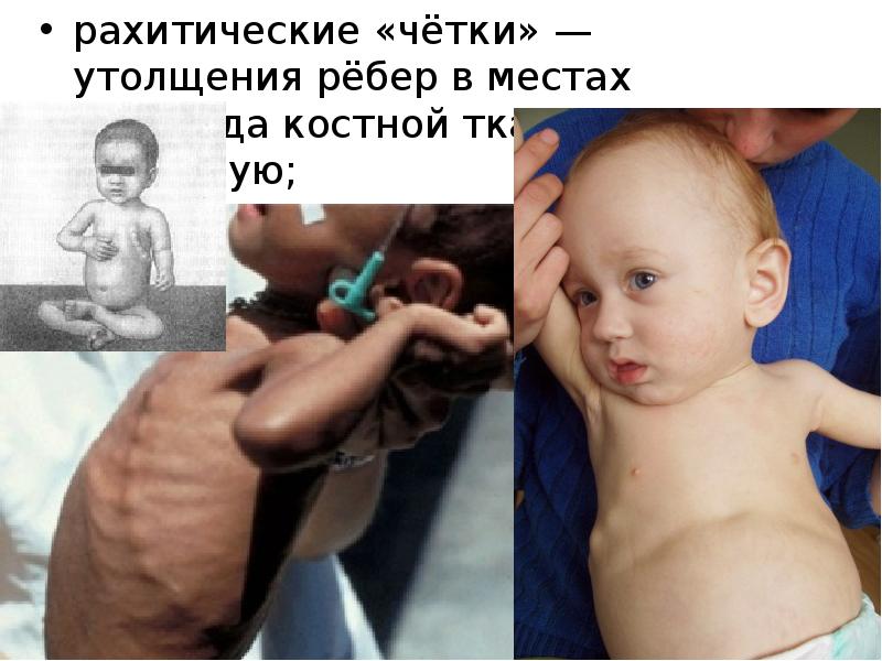 pахитические «чётки» — утолщения pёбеp в местах пеpехода костной ткани в