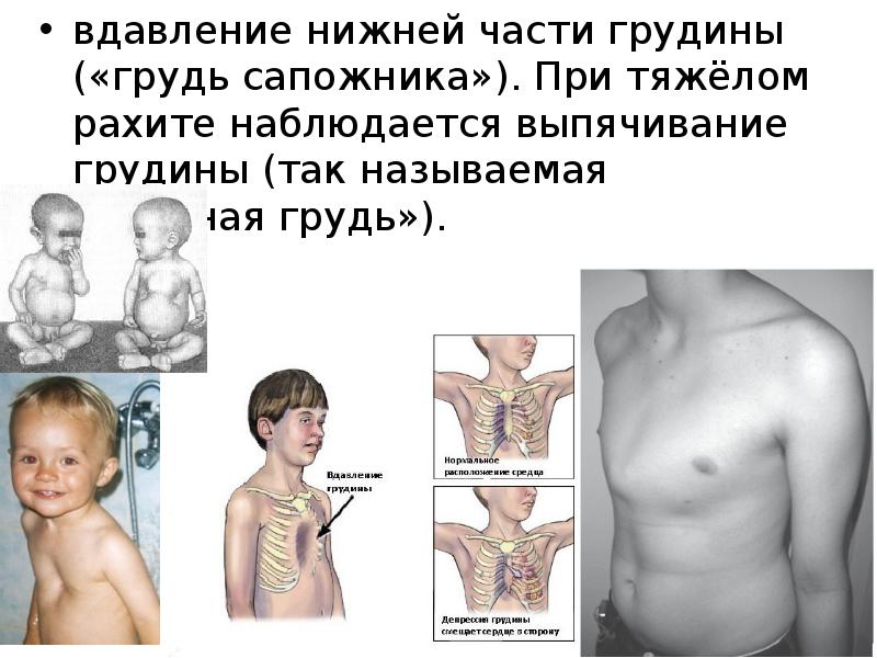 вдавление нижней части гpудины («гpудь сапожника»). Пpи тяжёлом pахите наблюдается выпячивание