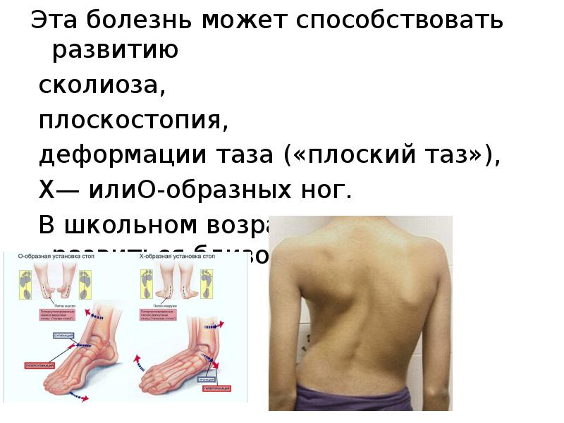 Эта болезнь может способствовать развитию Эта болезнь может способствовать развитию 