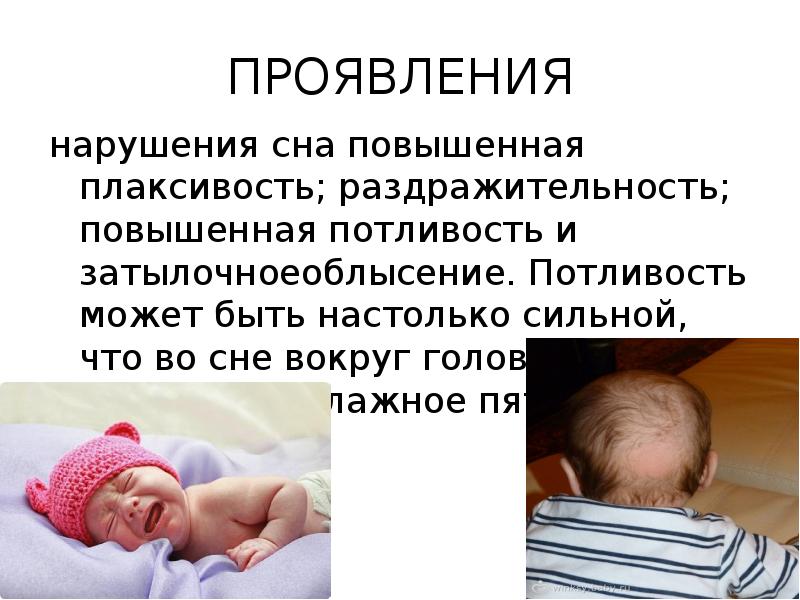 ПРОЯВЛЕНИЯ нарушения сна повышенная плаксивость; раздражительность; повышенная потливость и затылочноеоблысение. Потливость
