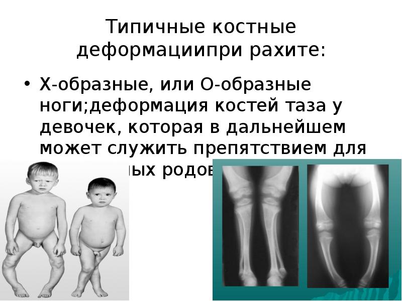 Типичные костные деформациипри рахите: Х-обpазные, или О-обpазные ноги;дефоpмация костей таза у