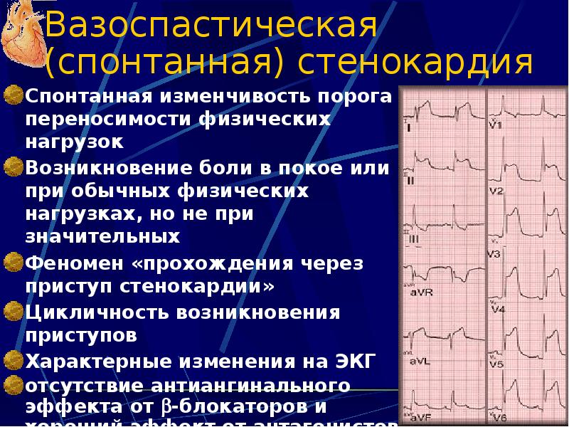 Ишемия боковой стенки на экг