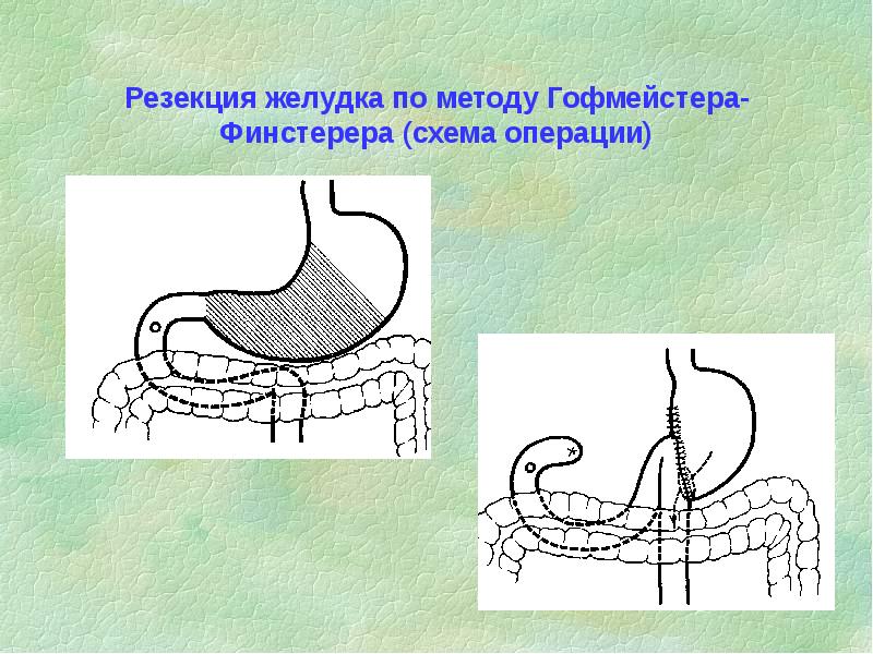 Резекция желудка по витебскому схема операции