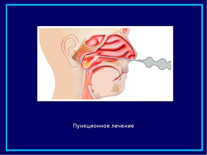 Гайморит презентация