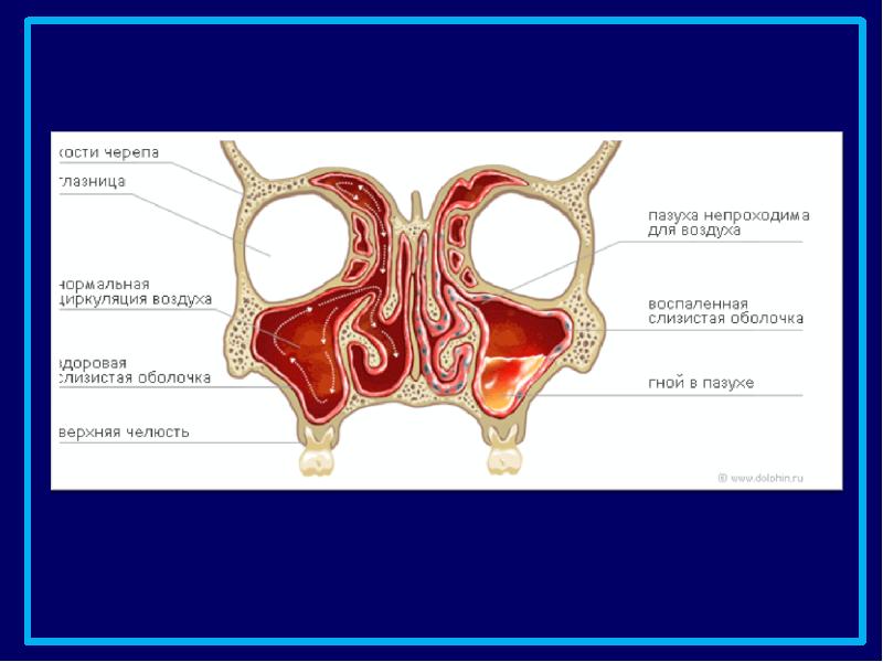 Пазухи носа картинки анатомия гайморит