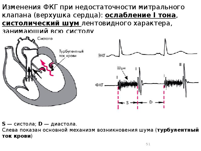 Аускультативная картина аортального стеноза