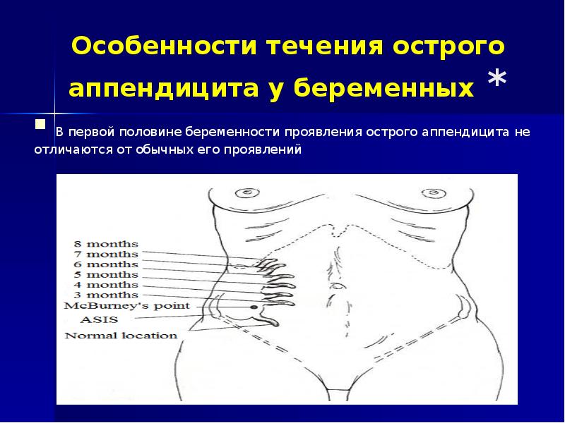 Острый аппендицит у беременных презентация