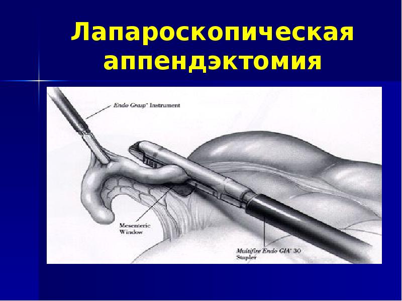 Удаление Аппендицита Цена