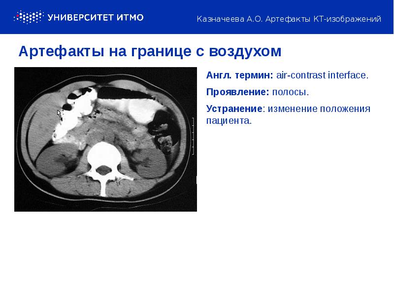 Артефакты мрт презентация