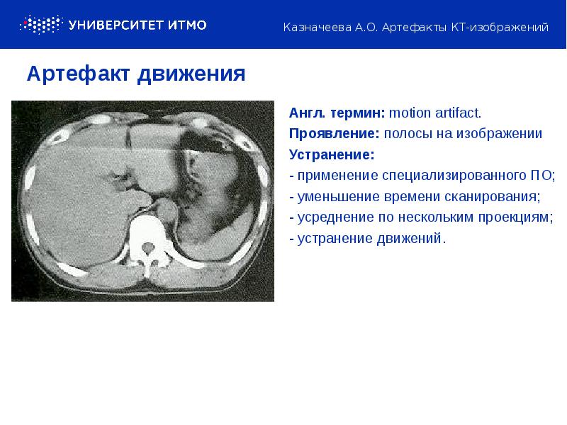 Артефакты мрт презентация