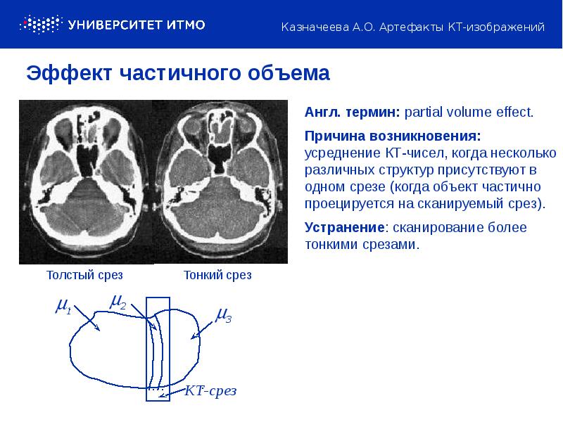 Артефакты мрт презентация