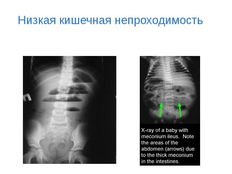 Врожденная кишечная непроходимость презентация