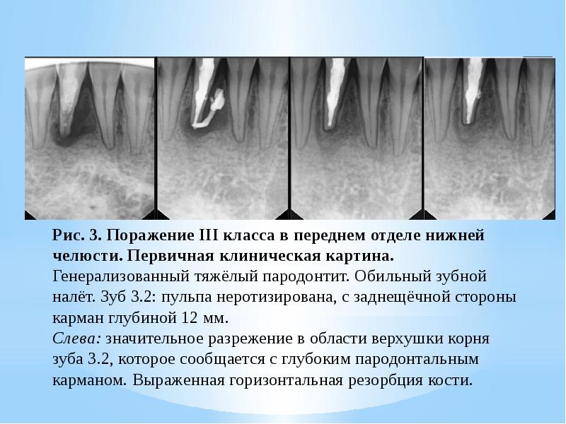 Резорбция это. Резорбция корней зубов. Механическая и медикаментозная обработка корневых каналов. Горизонтальная резорбция. Причины резорбции корня зуба.