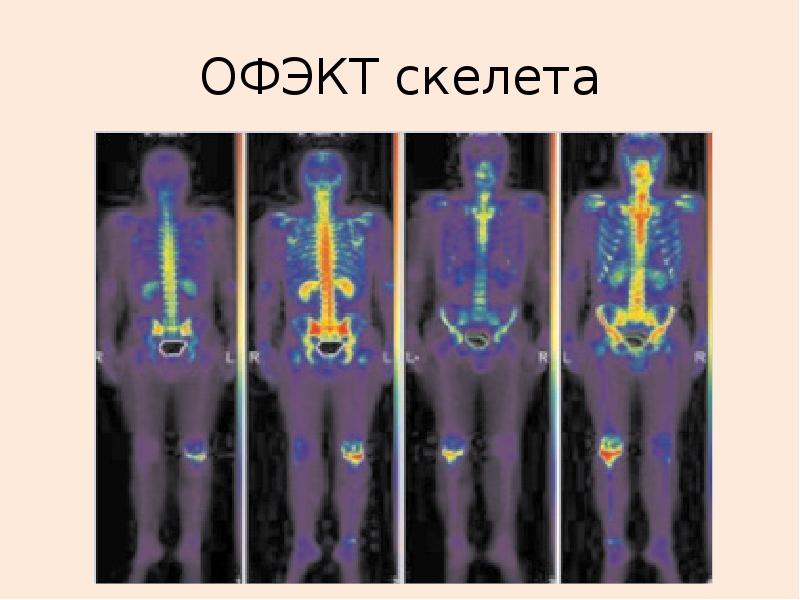 Кт костей скелета. ОФЭКТ костей скелета. ОФЭКТ кт скелета. ОФЭКТ костной системы. Технеций при ОФЭКТ скелета.