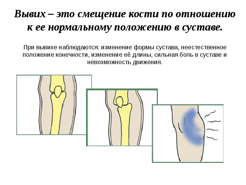 Переломы вывихи презентация