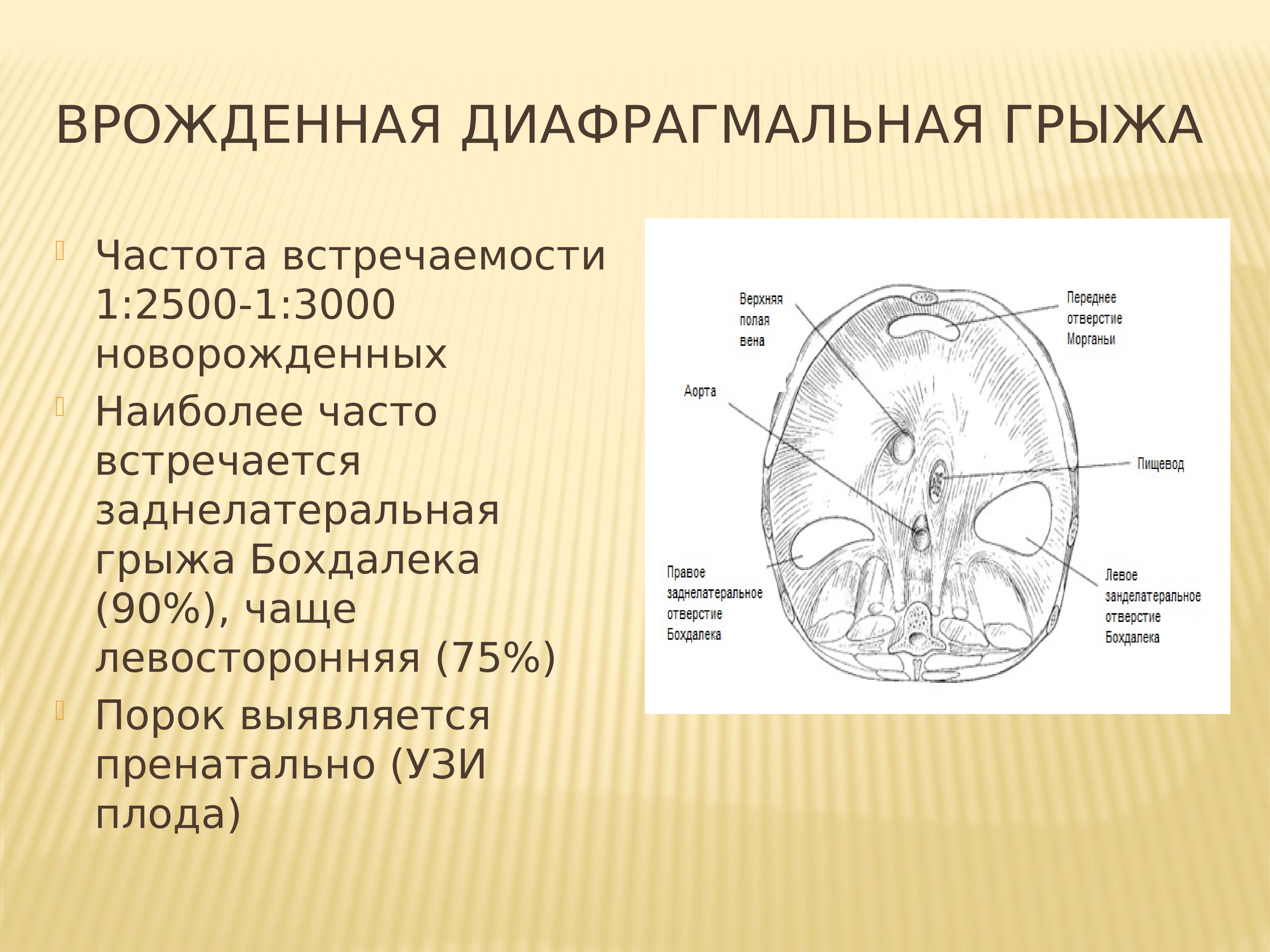 Врожденная диафрагмальная грыжа презентация