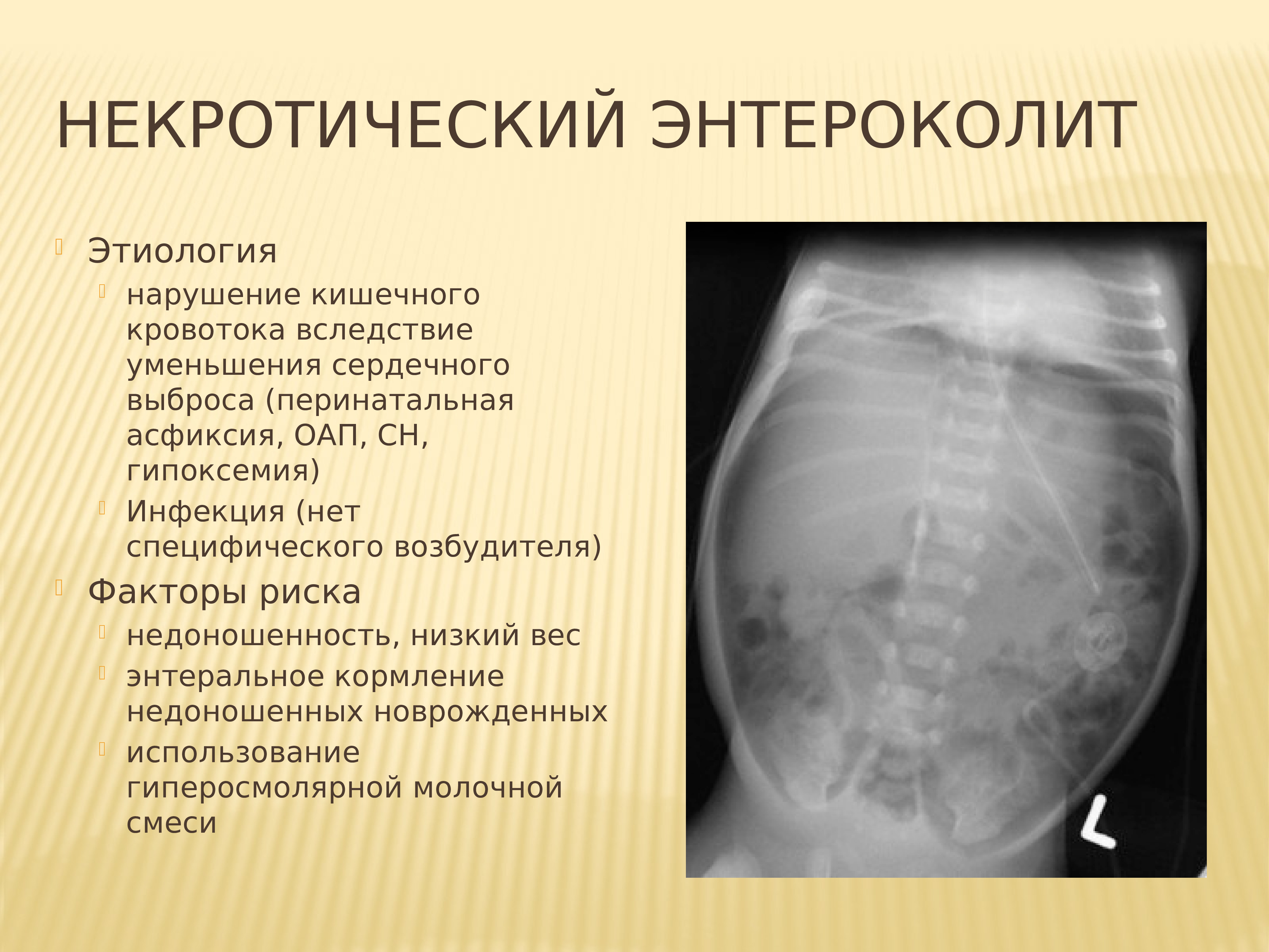 Некротизирующий энтероколит у новорожденных презентация