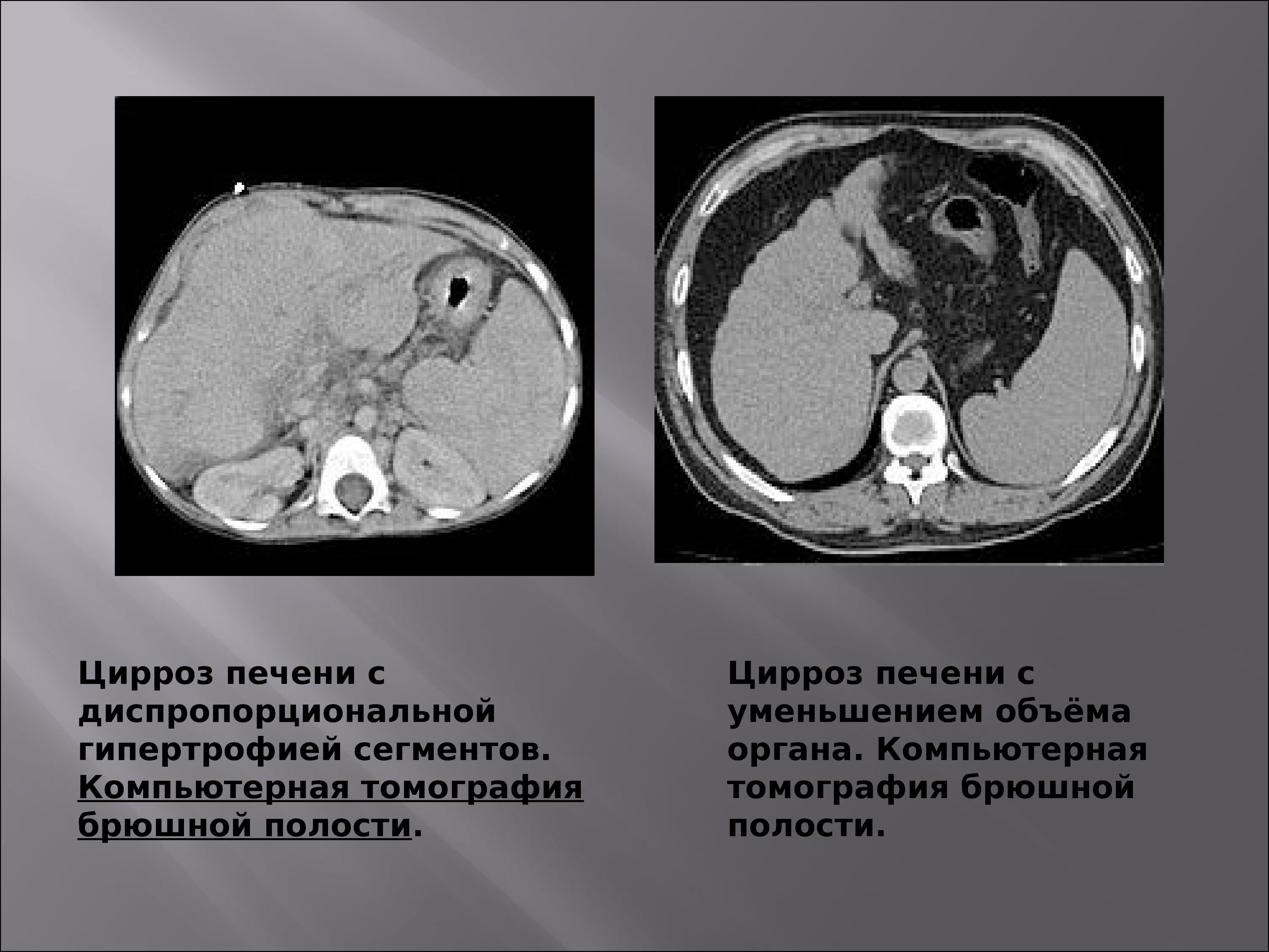 Компьютерная томография кт цирроз печени