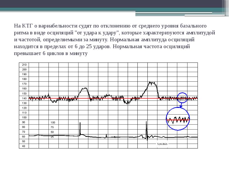 Кардиотокография (КТГ) плода при беременности