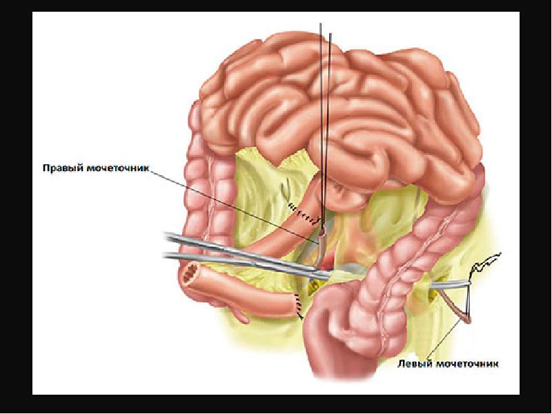 Неспецифический язвенный колит (няк). Язвенный колит толстого кишечника. Кишечник и вздутие живота. Кишечник и вздутие живота. Спастическое сокращение кишечника.