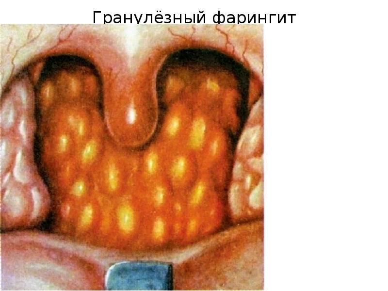 Гранулёзный фарингит Гранулёзный фарингит