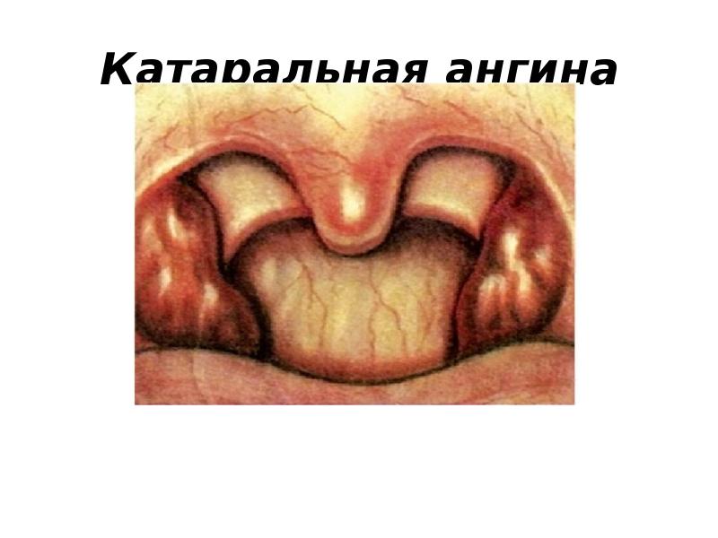 Катаральная ангина Катаральная ангина