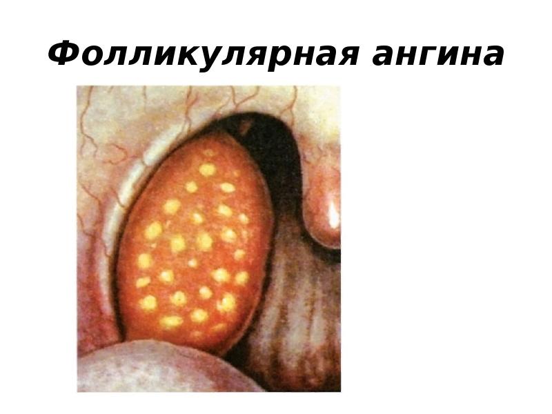 Фолликулярная ангина Фолликулярная ангина
