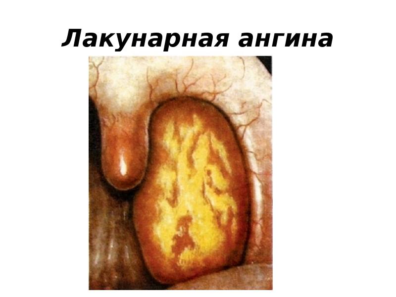 Лакунарная ангина Лакунарная ангина