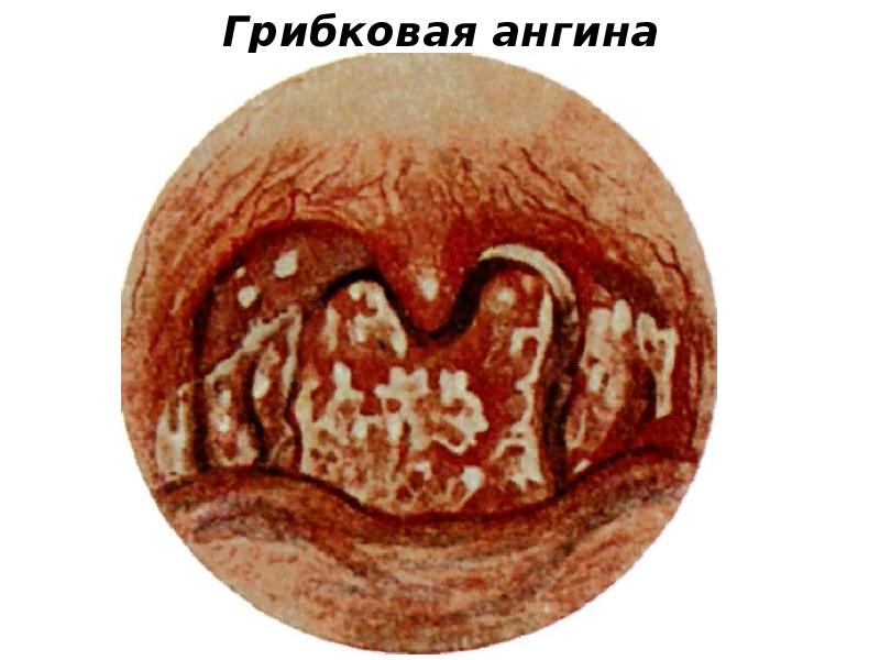 Грибковая ангина Грибковая ангина
