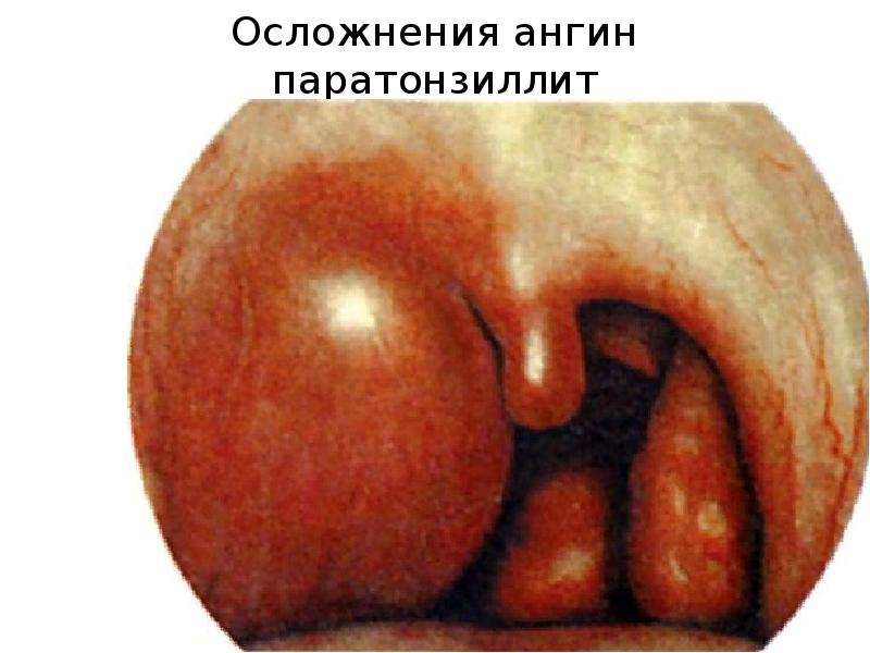 Осложнения ангин паратонзиллит Осложнения ангин паратонзиллит