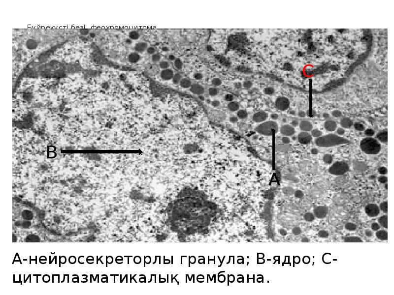 Бүйрек үсті безі аурулары презентация