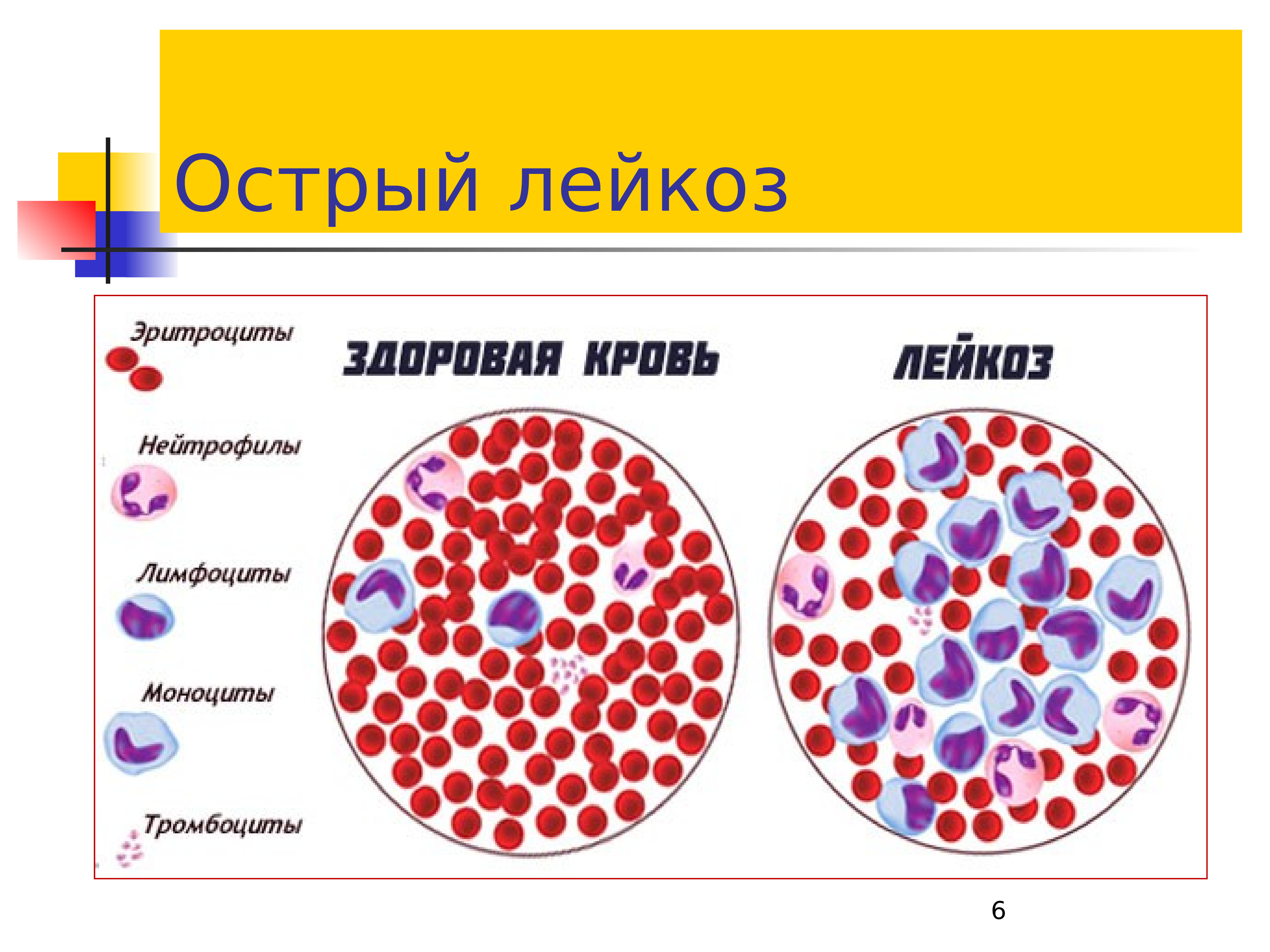 Лейкоз у детей презентация