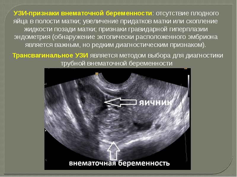Внематочная беременность операция сроки. Критерии внематочной беременности. Внематочная беременность на УЗИ. Внематочная беременность симптомы. Первые признаки внематочной.