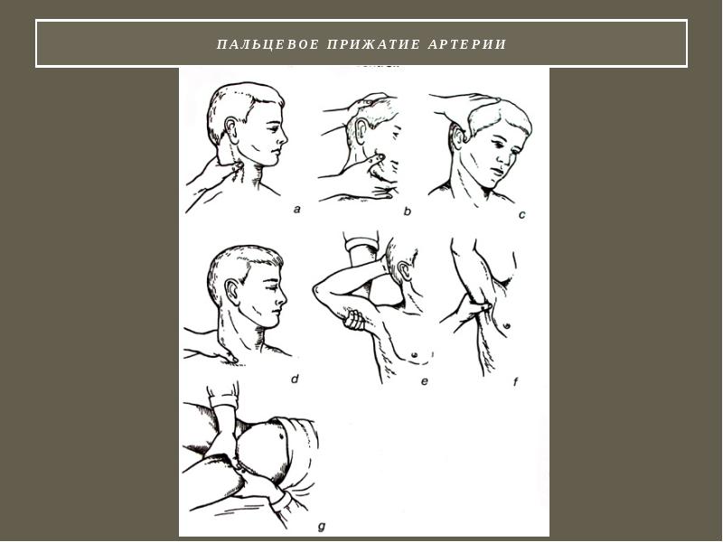 Прижатие сонной. Пальцевое прижатие сосуда. Пальцевое прижатие артерий. Прижатие нижнечелюстной артерии. Пальцевое пережатие артерии.