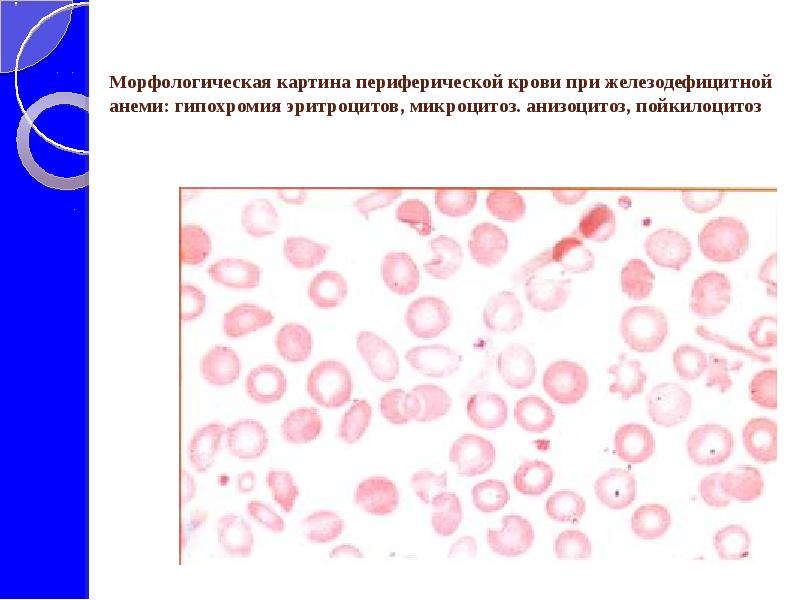 Анизоцитоз эритроцитов. Микроцитоз анизоцитоз пойкилоцитоз. Анизоцитоз микроцитоз пойкилоцитоз гипохромия. Анизоцитоз при анемии. Гипохромная анемия картина крови.